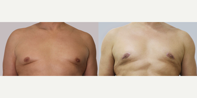 55-64 year old man treated with Gynecomastia Surgery - 55-64 year old man treated with Gynecomastia Surgery, shown 6 months post op.