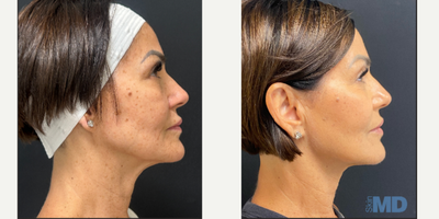 45-54 year old woman treated with NeoGen Plasma - This lovely patient is seeing tremendous improvement of her skin texture, tone and tightness.