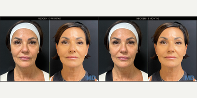 45-54 year old woman treated with NeoGen Plasma - This lovely patient is seeing tremendous improvement of her skin texture, tone and tightness.