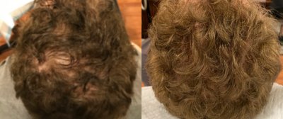 55-64 year old man treated with PRP for Hair Loss - Hair restoration treatment with PRP.