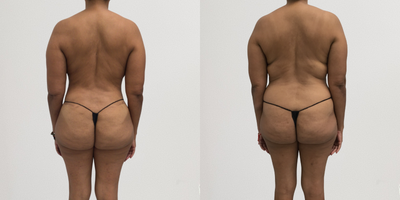 55-64 year old woman treated with Mommy Makeover, Liposuction, Breast Lift - Patient uderwent an extended abdominoplasty & bilateral breast reduction with lift (no implants), liposuction to bilateral flanks and full back