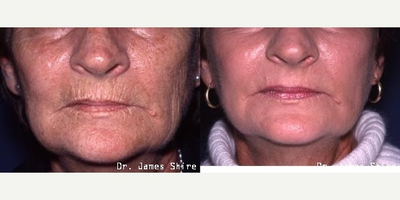 55-64 year old woman treated with Chemical Peel - Patient 4 years after deep chemical peel.&nbsp;