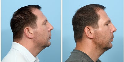 35-44 year old man treated with Chin Filler - Chin and jawline filler with Dr. Wise