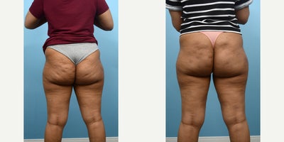 18-24 year old woman treated with Qwo - interim results for 2 sessions of QWO - third session is required and full results will be available in about a month.
