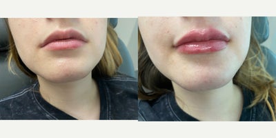 18-24 year old woman treated with Restylane Kysse - Dr. Wise added subtle volume and plump hydration to this 21-year-old patient's lips with Restylane Kysse lip filler.