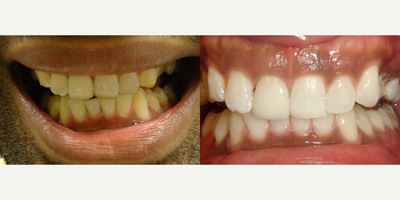 25-34 year old man treated with Teeth Whitening - This patient was able to achieve such a drastic difference in their tooth shade through our advanced KOR Whitening System with Dr. Kalpesh Patel.