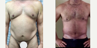 Full Body Intense Liposuction - Excellent outcome after Male Tummy Tuck + Maleliposuction including abdomen, waist, laterals, upper and lower back + Dr. MallolDominican Butt Lift.