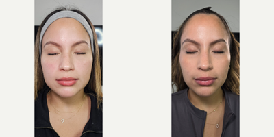25-34 year old woman treated with Botox for TMJ, Botox - MAESSTER BOTOX - JAWLINE SLIMMING BOTOX BEFORE AND 2 WEEKS AFTER