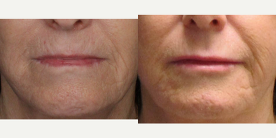 Lip Implants for this 64-Year-Old Woman - This 64-year-old female patient had lip implants to balance the face and improve the appearance of her lips.