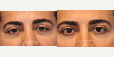45-54 year old woman treated with Restylane Silk - 46-year-old male, one syringe of Restylane silk under the eyelid for dark circle correction. 2 weeks post op.