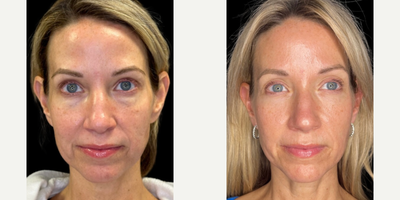 Patient treated with Sylfirm X - Patient treated with Sylfirm X
