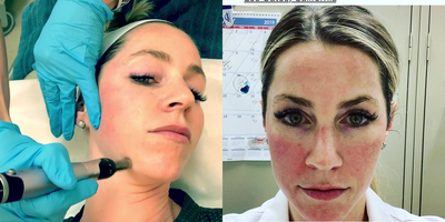 25-34 year old woman treated with Alastin Skincare - One Day post microneedling with Alastin Nectar on her left cheek only. Wow! What a difference! Rapid healing and better outcomes.