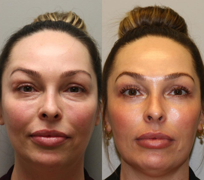 Woman treated with Skin Rejuvenation - Woman treated with Skin Rejuvenation through laser resurfacing, as well as lower eyelid blepharoplasty with fat transfer. Patient thinks her eyes and face did not adequately reflect her inner energy. She if shown 1 year post op.