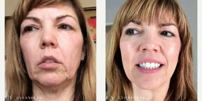 Vampire Facelift 45-54 year old woman - Dr. Zheng's patient following a Vampire Facelift series to rejuvenate the skin and reduce wrinkles. Also known as platelet-rich plasma (PRP) therapy.