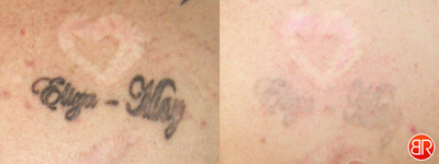 Tattoo Removal - Patient has had 4 treatments for tattoo removal. The patient will require a further 1-2 sessions for complete removal.