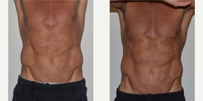 45-54 year old man treated with CoolTone - Our 52 year old patient had 4 Cooltone treatments to his abdomen. The after photo is taken directly after his 4th session.