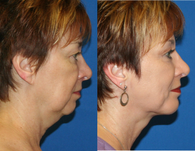 45-54 year old woman treated with Non-Surgical Neck Lift - 50 year old woman treated with Non-Surgical Neck Lift