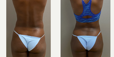 25-34 year old woman treated with Liposuction - 31 yo s/p liposuction abdomen and flanks with fat grafting to buttocks performed in our AAAA certified operating suite.