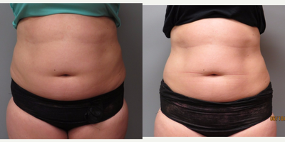 UltraShape Before and After - 33 year old female wanted to reduce the size of her abdomen & received a series of 3 UltraShape treatments, 2 weeks apart. The patient reported a 3 inch reduction in her abdominal area. This is the equivalent of 2 dress sizes.