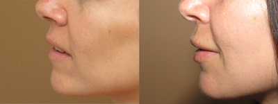 kissable lips - lip augmentation using fat transfer - 
	Natural lip augmentation using fat transfer
