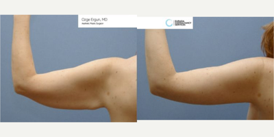 45-54 year old woman treated with Arm Lift - Arm Lift Surgery