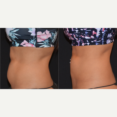 BodyTite before and after photo