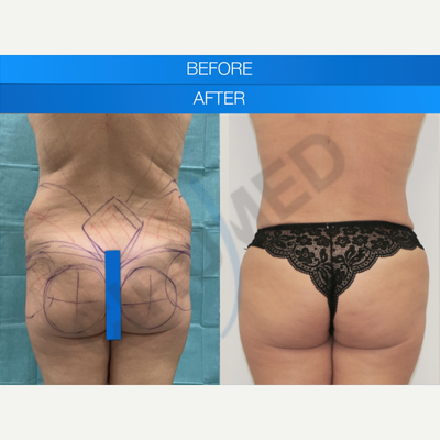 Tummy Tuck before and after photo