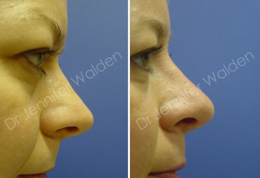 Septoplasty before and after photo