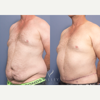 Body Lift before and after photo