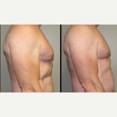 Liposuction before and after photo