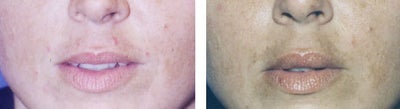 Lip Fillers before and after photo