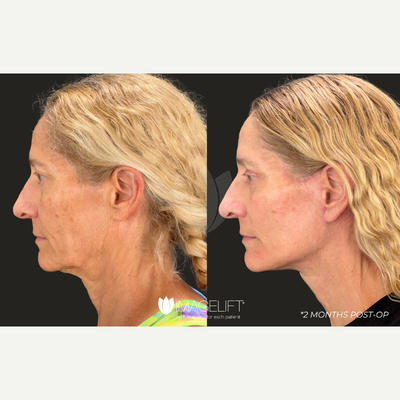 Deep Plane Facelift before and after photo