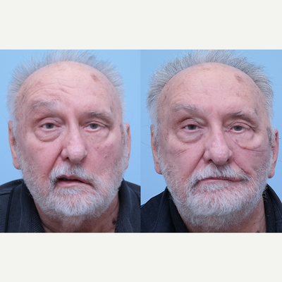 Facial Reconstructive Surgery before and after photo
