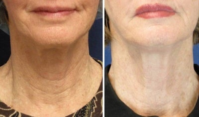 ThermiTight before and after photo