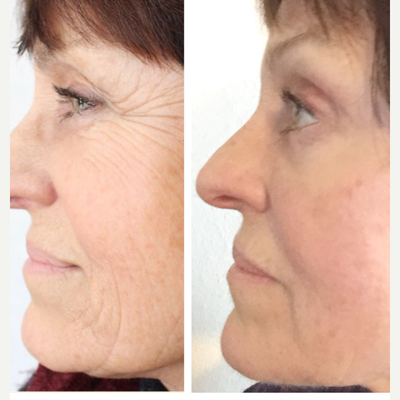 PRP Injections before and after photo