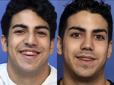Rhinoplasty before and after photo