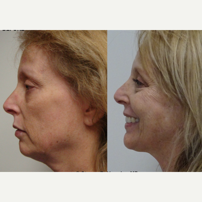 Facelift before and after photo