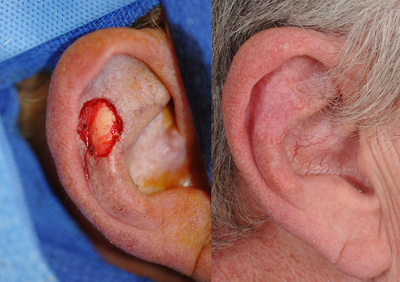 Facial Reconstructive Surgery before and after photo