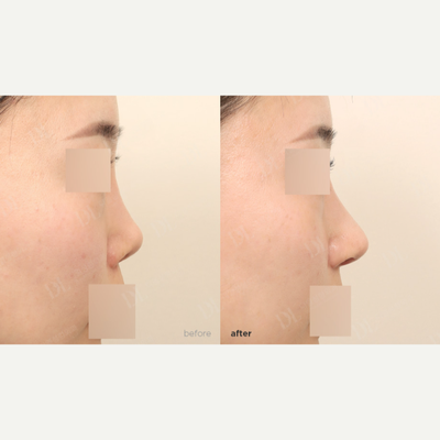 Asian Rhinoplasty before and after photo