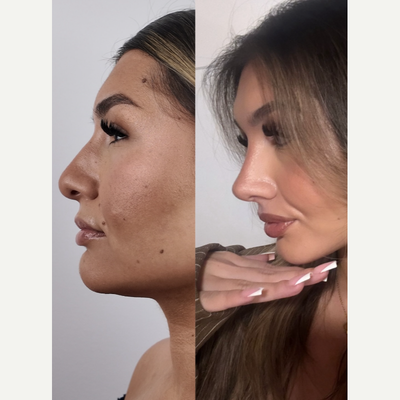 Rhinoplasty before and after photo
