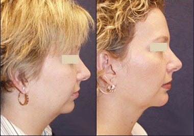 Chin Liposuction before and after photo
