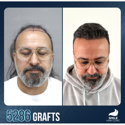 FUE Hair Transplant before and after photo