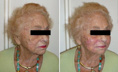 Dermal Fillers before and after photo