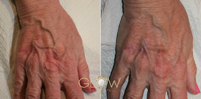 Radiesse before and after photo