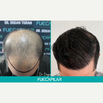 FUE Hair Transplant before and after photo
