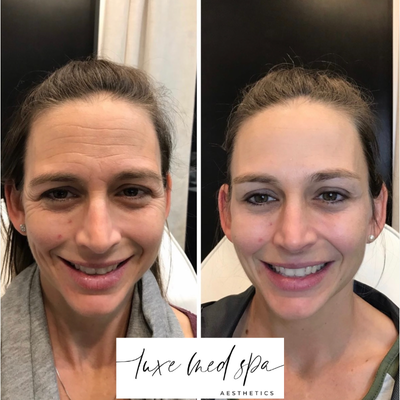Dysport before and after photo