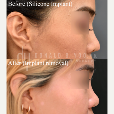 Rhinoplasty before and after photo