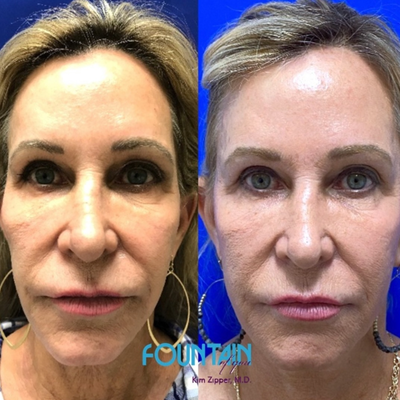 Restylane Refyne before and after photo