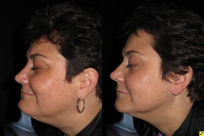 Thermage before and after photo
