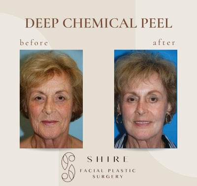 Chemical Peel before and after photo